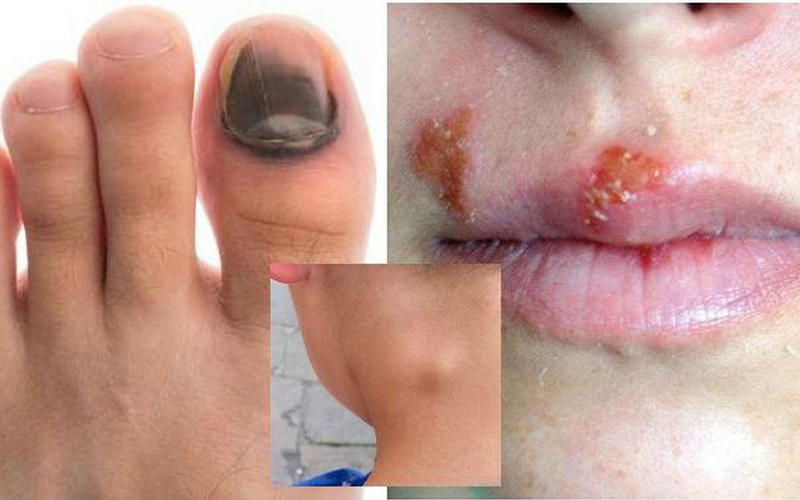 Bệnh HIV là triệu chứng gây suy giảm hệ miễn dịch ở người do một loại vi khuẩn có tên là Human Immunodeficiency Virus gây nên