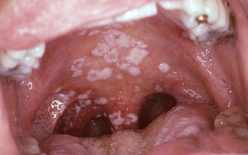 Bệnh Chlamydia gây ra bởi vi khuẩn đặc biệt Chlamydia