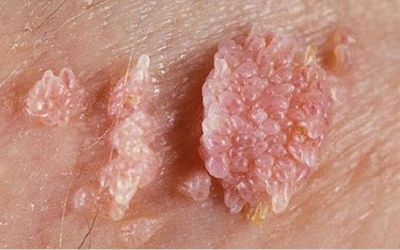 Một trong những bệnh nam khoa thường gặp lây truyền qua đường tình dục đó chính là bệnh sùi mào gà