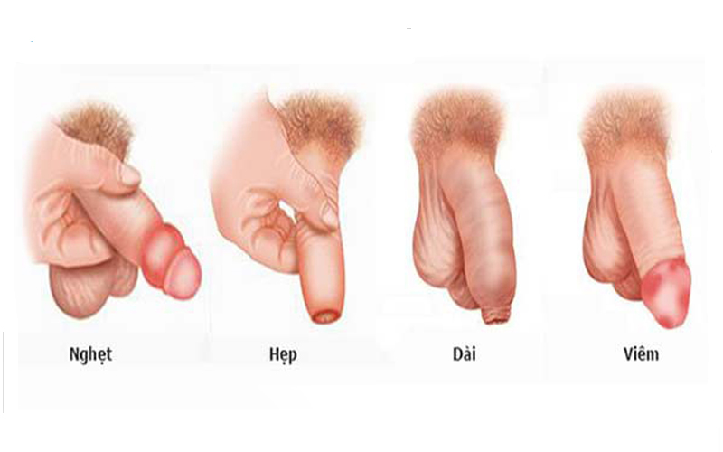 cách chữa viêm bao quy đầu