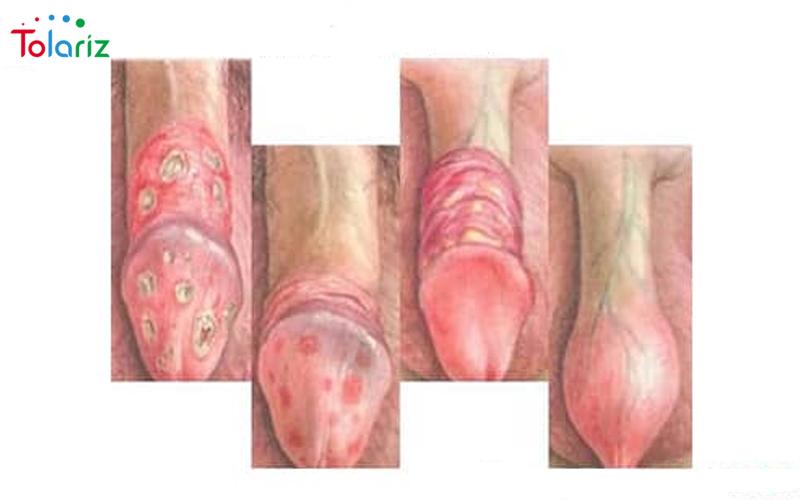 Top 12+ Cách chữa viêm bao quy đầu tại nhà hiệu quả nhất