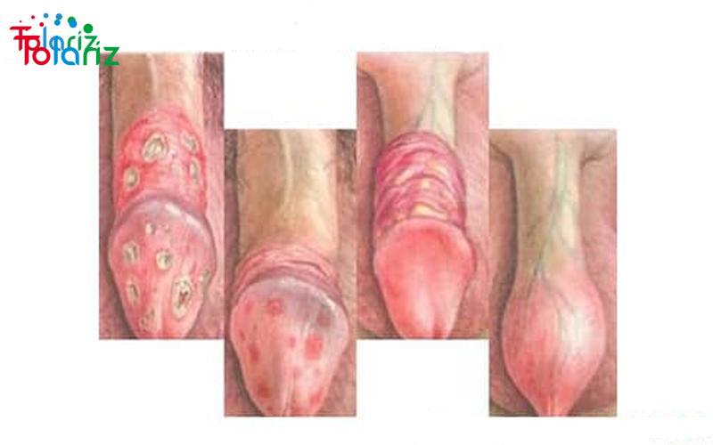 cách chữa viêm bao quy đầu