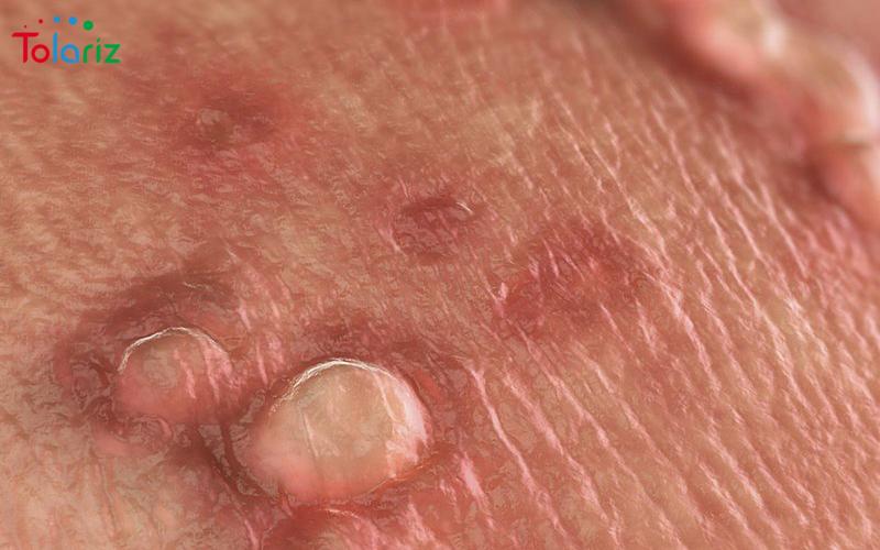 Sùi mào gà ở nam giới có nguy hiểm không? Điều trị ra sao?