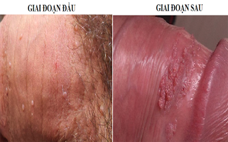 bệnh sùi mào gà ở nam giới