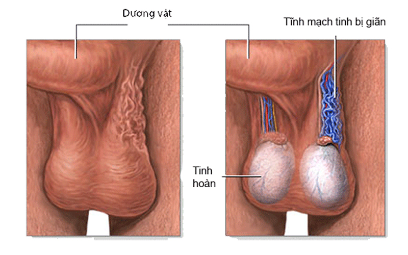 Không phát hiện được trên lâm sàng cũng như là không thể nhận thấy các dấu hiệu bằng mắt thường.