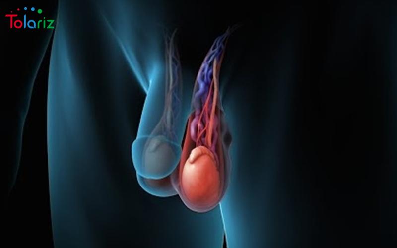 Giãn tĩnh mạch thừng tinh là gì? – Nguyên nhân, cách chữa