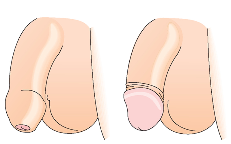 có nên cắt bao quy đầu