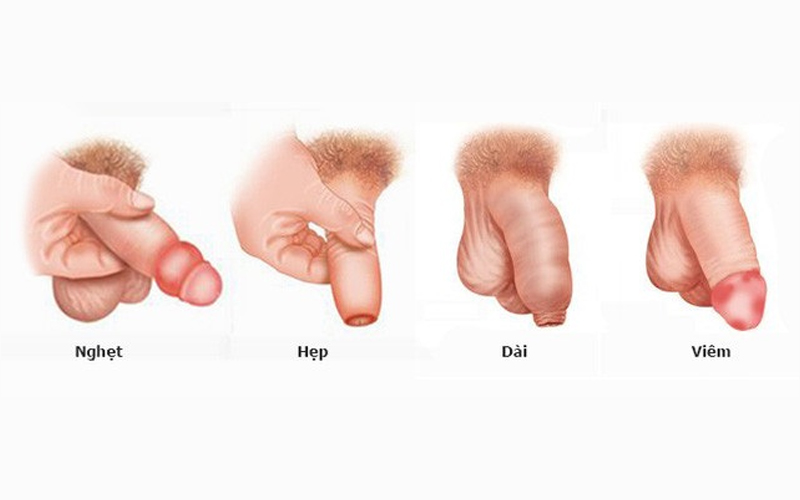 các trường hợp cần cắt bao quy đầu