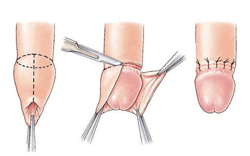 Quy trình cắt bao quy đầu