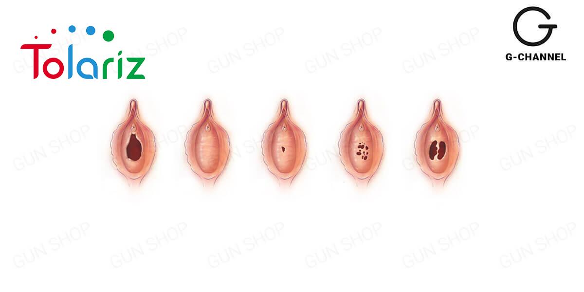 Quan hệ dùng lưỡi có bị rách màng trinh không?