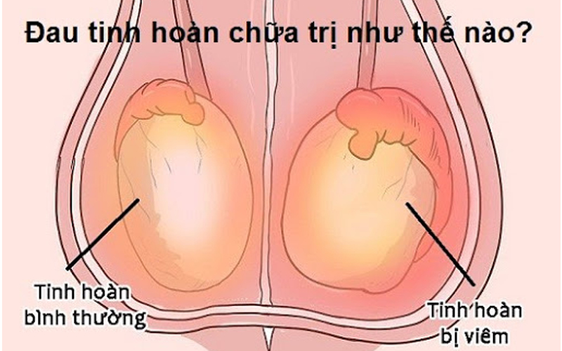 thường được điều trị bằng thuốc kháng sinh hoặc thuốc kháng virus kết hợp với thuốc chống viêm không Steroid