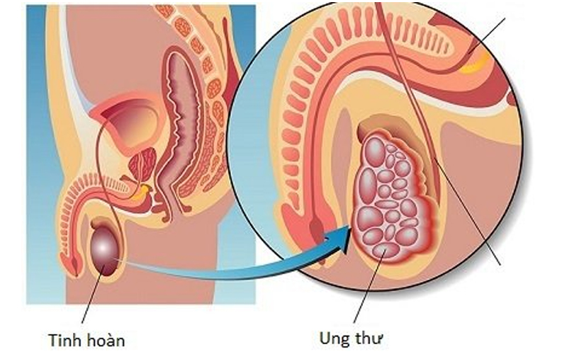Để điều trị được căn bệnh này, các bác sĩ buộc phải loại bỏ những phần mô bị ung thư